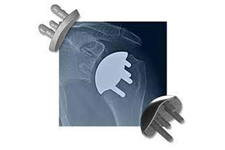 catalyst shoulder implant - best shoulder replacement surgeons in New Hampshire