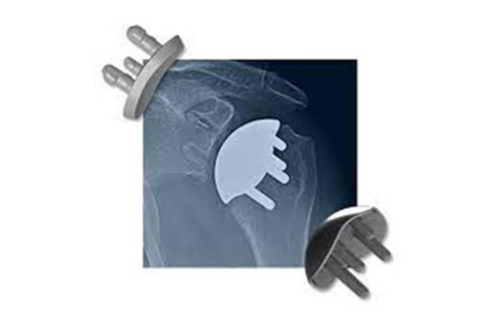 catalyst shoulder replacement concept - best shoulder replacement surgeons in New Hampshire