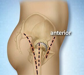anterior hip replacement surgery portsmouth nh