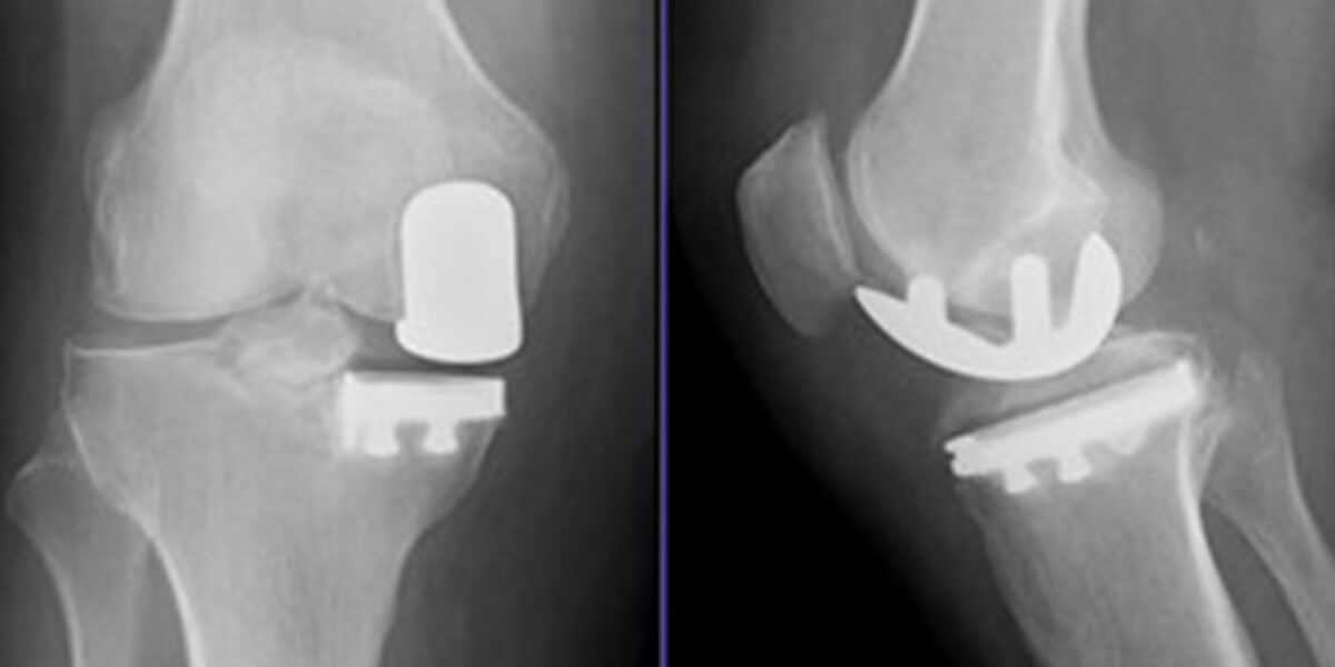 Partial Vs Total Knee Replacement Surgery Portsmouth Nh