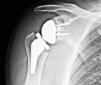 stemless short term shoulder replacement surgery portsmouth nh 3