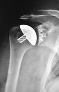 stemless short term shoulder replacement surgery portsmouth nh 5