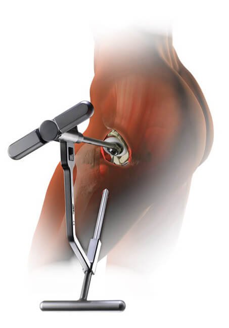 top ten reasons for superpath hip replacement in portsmouth nh